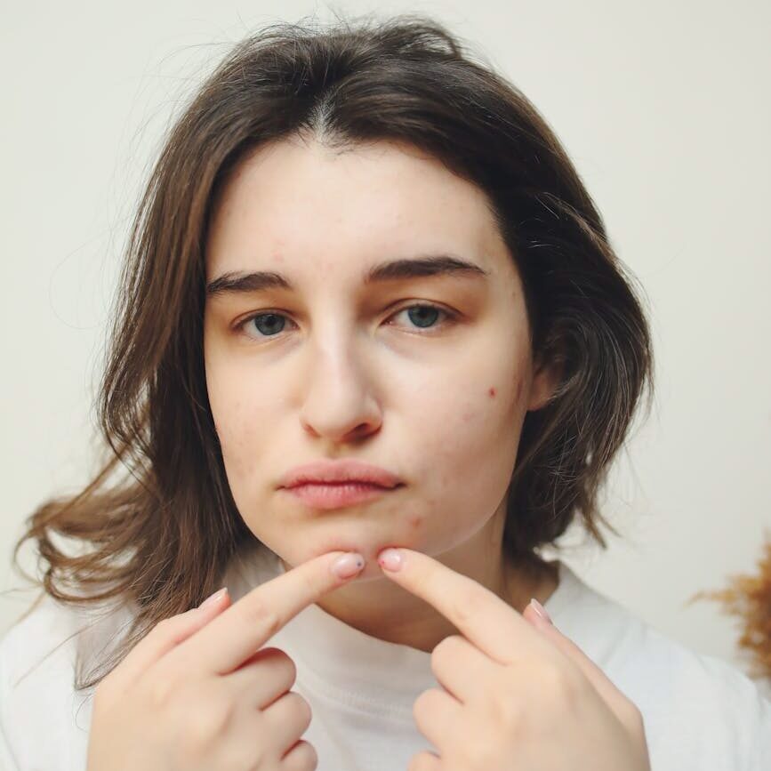 The Ultimate Guide to the Best Pimple Patches You Can Buy